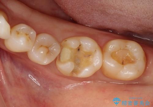30代女性　奥歯の銀歯をセラミックで白い歯にの治療中