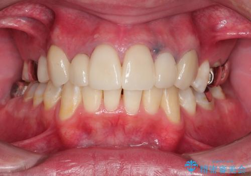 20代男性　前歯の保険クラウンをセラミッククラウンへ　歯肉の変色も改善の治療後