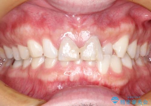 30代男性　部分矯正+前歯のセラミッククラウンの治療前