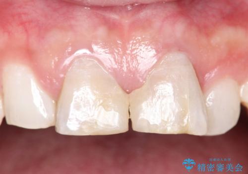 30代男性　部分矯正+前歯のセラミッククラウンの症例 治療前