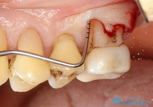 40代女性　膿の止まらない奥歯の処置の症例 治療前
