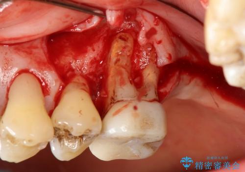 40代女性　膿の止まらない奥歯の処置