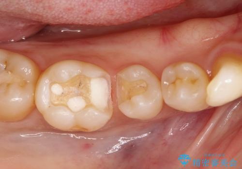 30代女性　奥歯の銀歯をセラミックで白い歯にの治療中