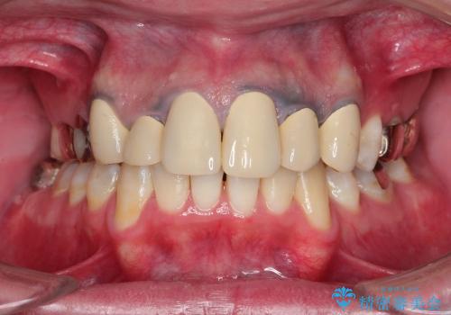 20代男性　前歯の保険クラウンをセラミッククラウンへ　歯肉の変色も改善の治療前