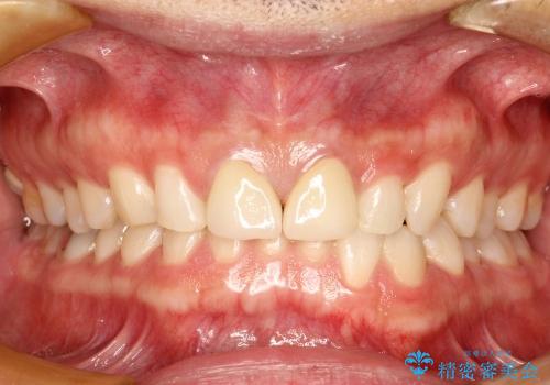 30代男性　部分矯正+前歯のセラミッククラウンの治療後