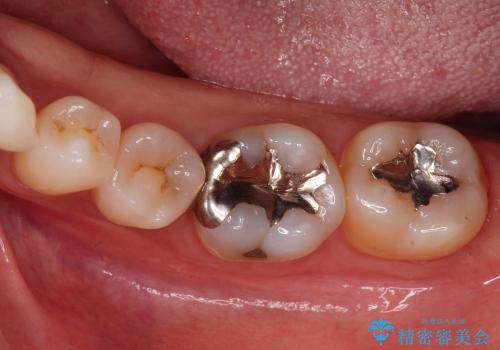 30代女性　奥歯の銀歯をセラミックで白い歯にの治療前