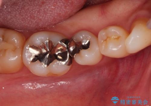 30代女性　奥歯の銀歯をセラミックで白い歯にの治療前