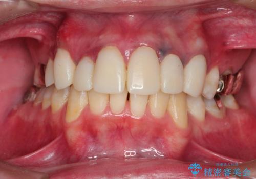 20代男性　前歯の保険クラウンをセラミッククラウンへ　歯肉の変色も改善の治療中