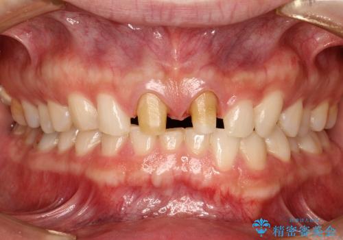 30代男性　部分矯正+前歯のセラミッククラウンの治療中