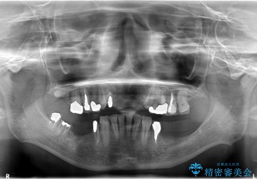 全顎治療　骨の無い下顎のインプラントの治療前