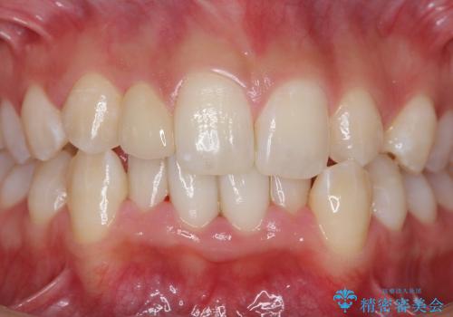 矮小歯の形態改善の治療後