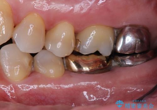 40代女性　奥歯のかぶせものがすぐに外れる　歯冠長延長術