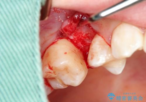歯周病の歯を残す　歯槽骨の再生治療の治療後