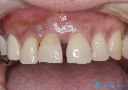重度歯周病 　歯を残す治療の症例 治療前