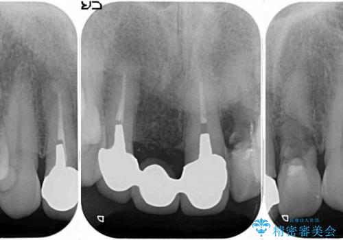 40代女性　前歯の歯茎から膿が出る　オールセラミックブリッジによる審美治療の治療前