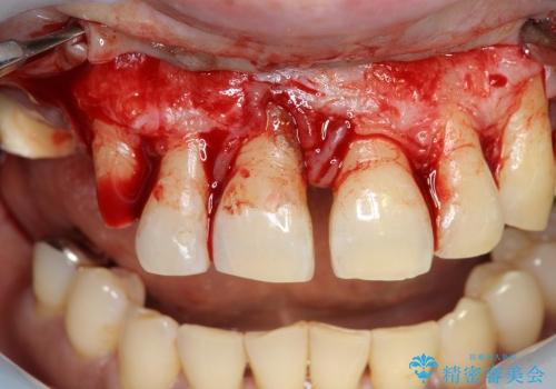 重度歯周病 　歯を残す治療の治療中