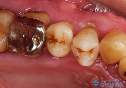 歯周病　分岐部病変に対する対応の治療前