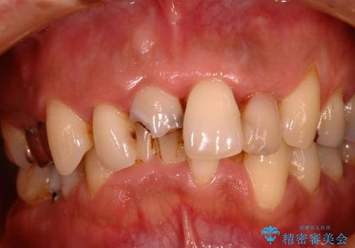 歯周病、矯正、被せものフルコース治療の治療前