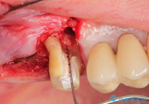 歯周病　分岐部病変に対する対応の治療中