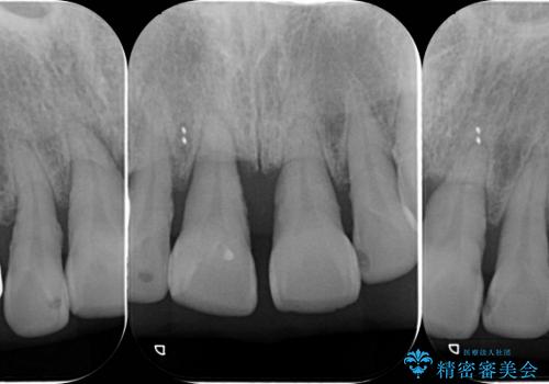 重度歯周病 　歯を残す治療の治療前
