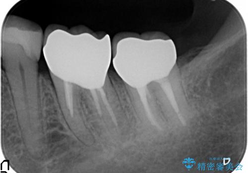 40代女性　奥歯のかぶせものがすぐに外れる　歯冠長延長術の治療後