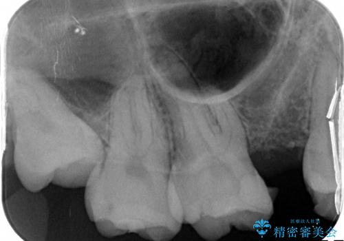 歯周病の歯を残す　歯槽骨の再生治療の治療後