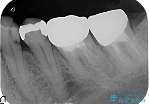 40代女性　奥歯のかぶせものがすぐに外れる　歯冠長延長術の治療前
