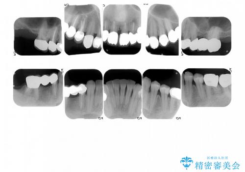 歯周病、矯正、被せものフルコース治療の治療後