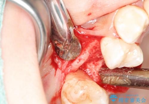 歯周病の歯を残す　歯槽骨の再生治療の治療前