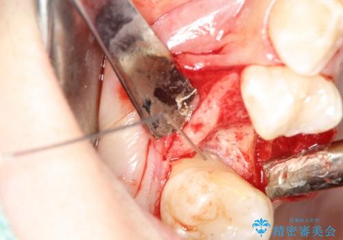 歯周病の歯を残す　歯槽骨の再生治療の治療中