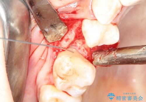 歯周病の歯を残す　歯槽骨の再生治療