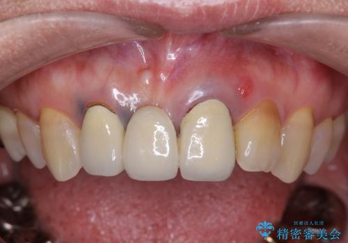 40代女性　前歯の歯茎から膿が出る　オールセラミックブリッジによる審美治療の治療前
