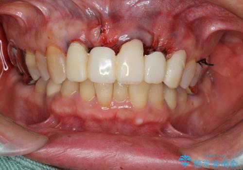 40代女性　前歯の歯茎から膿が出る　オールセラミックブリッジによる審美治療の治療中