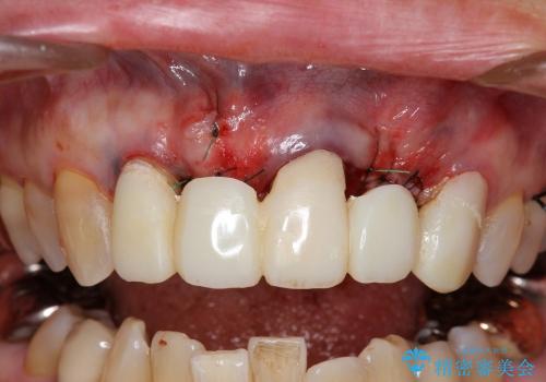 40代女性　前歯の歯茎から膿が出る　オールセラミックブリッジによる審美治療の治療中