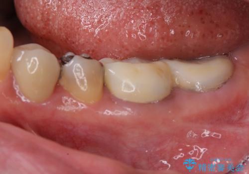 40代女性　奥歯のかぶせものがすぐに外れる　歯冠長延長術の治療前
