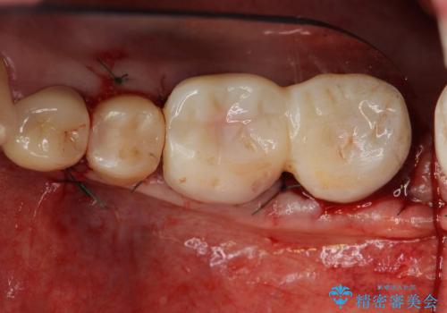 40代女性　奥歯のかぶせものがすぐに外れる　歯冠長延長術の治療中