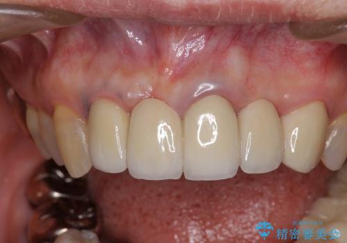 40代女性　前歯の歯茎から膿が出る　オールセラミックブリッジによる審美治療の治療後