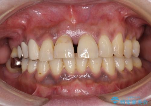 重度歯周病 　歯を残す治療の治療前