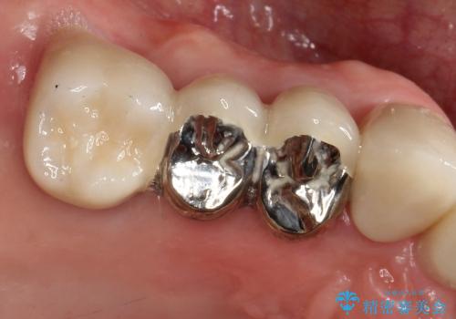 歯周病　分岐部病変に対する対応の治療後