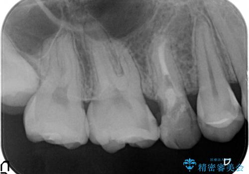 歯周病の歯を残す　歯槽骨の再生治療の治療前