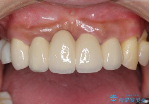 重度歯周病 　歯を残す治療の症例 治療後
