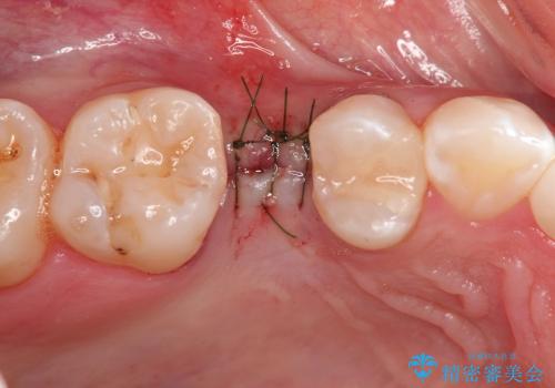 歯周病の歯を残す　歯槽骨の再生治療の治療中