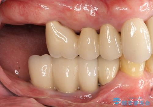 歯周病　分岐部病変に対する対応の治療後