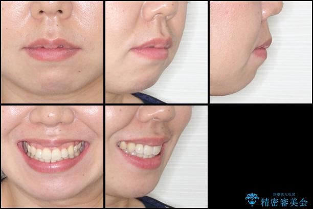 30代女性　でこぼこの前歯をきれいに　抜歯矯正　審美装置の治療後（顔貌）