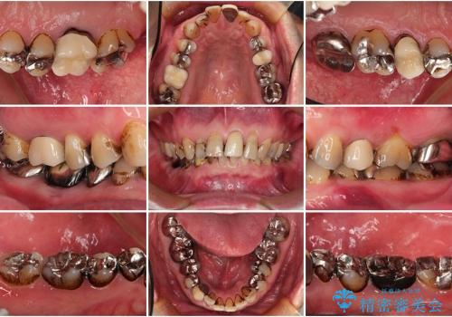 40代男性　銀歯を白く　虫歯だらけの歯を治したいの治療前