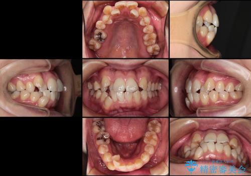 30代女性　でこぼこの前歯をきれいに　抜歯矯正　審美装置の治療前