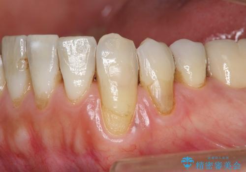 歯ぐきの再生治療の症例 治療前