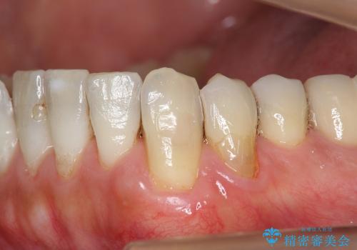 歯ぐきの再生治療の症例 治療後