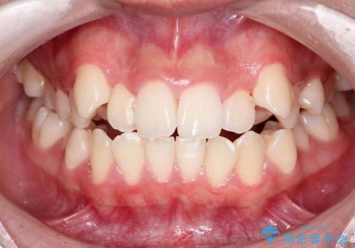 10代女性　八重歯　前歯のガタガタ