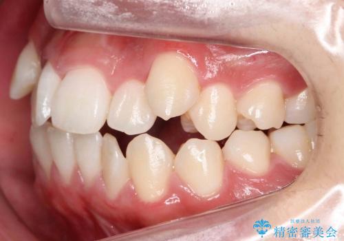 10代女性　八重歯　前歯のガタガタの治療前